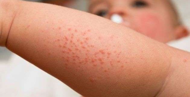 nella foto il braccio di un bimbo colpito da dermatite atopica