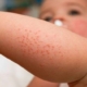nella foto il braccio di un bimbo colpito da dermatite atopica