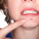 acne giovanile nell'immagine una giovane donna mostra un brufolo sotto le labbra