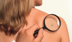 melanoma: come riconoscere i nei sospetti