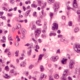 patologie eosinofile