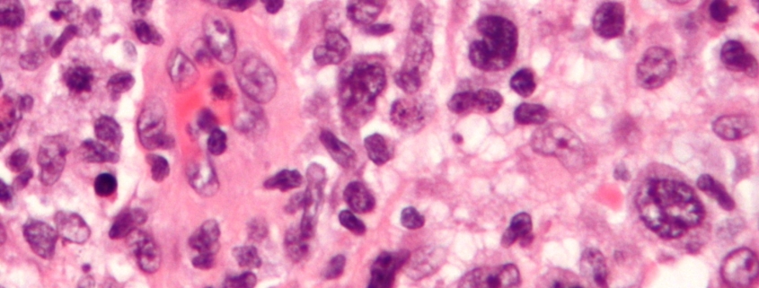 patologie eosinofile
