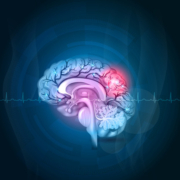 l'immagine di un cervello colpito da stroke