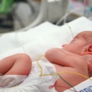 asmd, una bimba in incubatrice