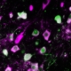 parkinson, l’alfa-sinucleina (verde) colonizza il corpo cellulare dei neuroni che producono dopamina (rosa) e ne distrugge le funzioni normali