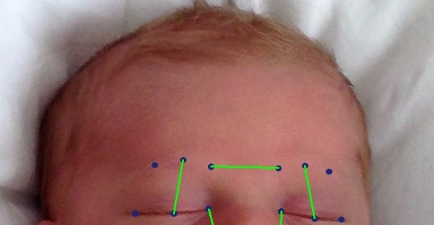 dolore, un app riconosce la mimica facciale nei bambini