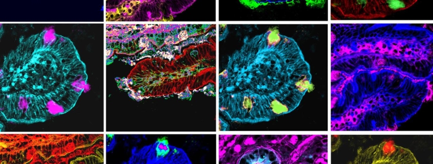 fibrosi cistica modifica il microbiota intestinale dei bambini