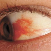 diabete, occhio con retinopatia diabetica