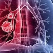 tumore del polmone, immagine 3d