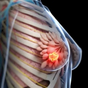 tumore al seno metastatico, immagine n 3d