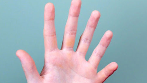 malattie rare: la mano di un bimbo