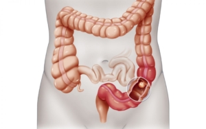 tumore, immagine colon retto