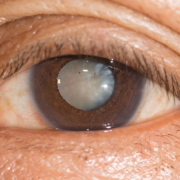 cataratta: occhio con pupilla schiarita
