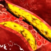 colesterolo cattivo 1200x716 1