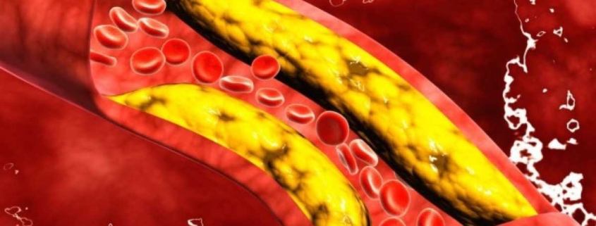 colesterolo cattivo 1200x716 1