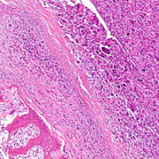 osteosarcoma