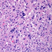 carcinoma adrenocorticale