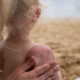 rischio melanoma: bimba al mare di spalle con la pelle scottata