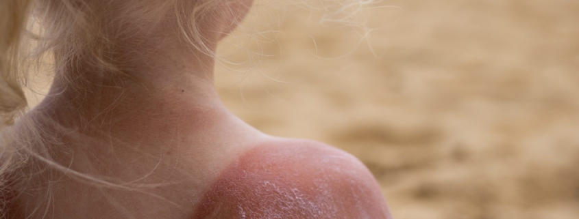 rischio melanoma: bimba al mare di spalle con la pelle scottata