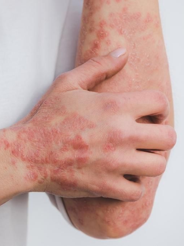 Psoriasi colpisce oltre 2 milioni di italiani