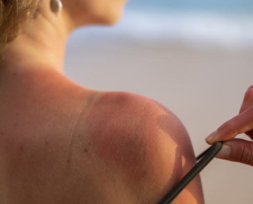 melanoma: donna di spalle mostra una spalla scottata dal sole