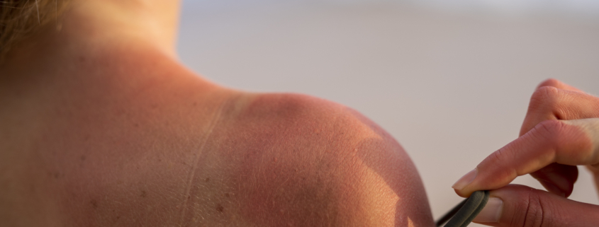 melanoma: donna di spalle mostra una spalla scottata dal sole