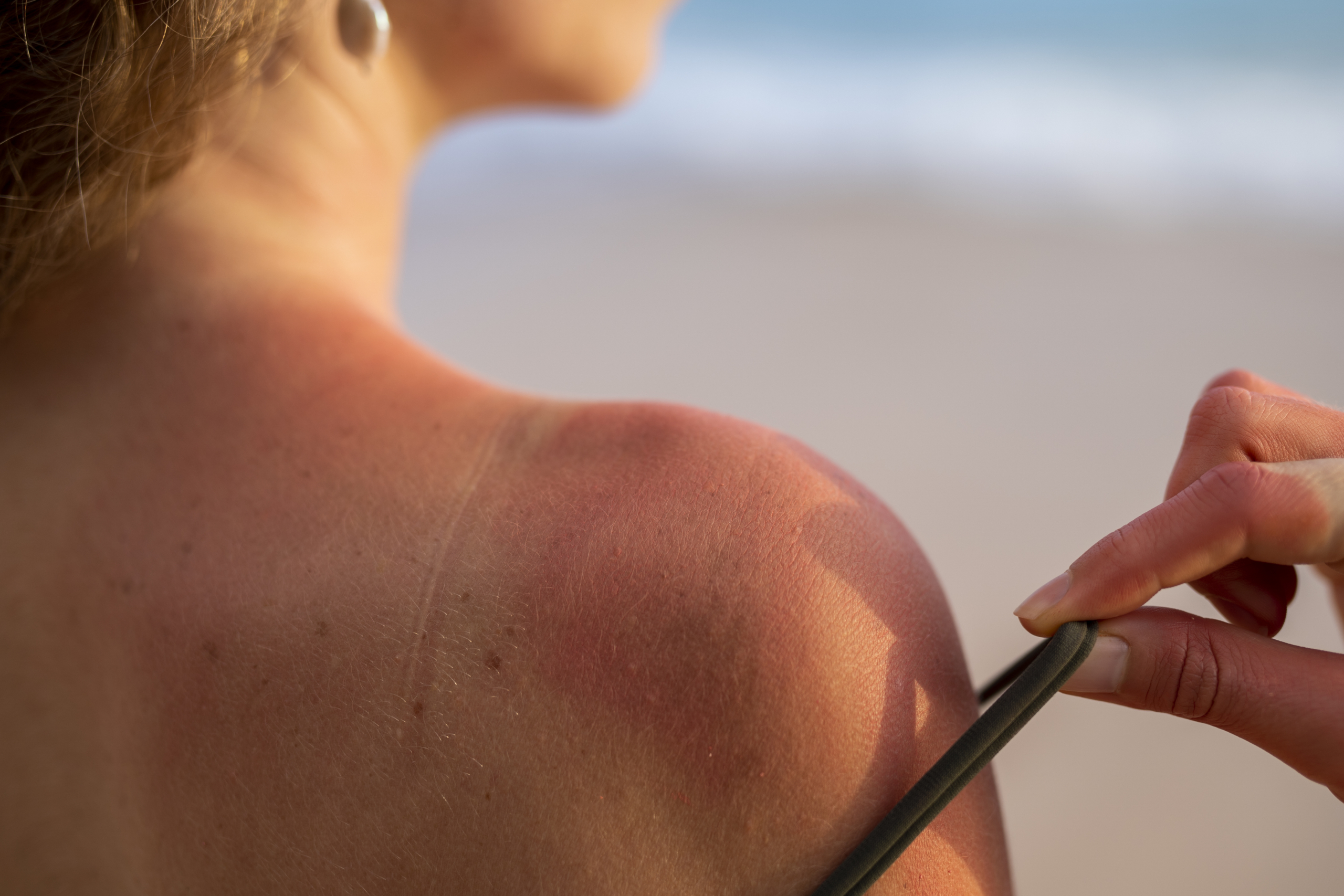 melanoma: donna di spalle mostra una spalla scottata dal sole 
