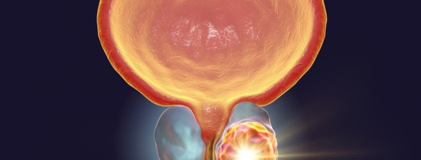 prostate cancer c84eb568