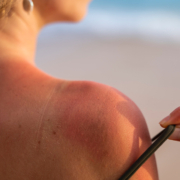 crema solare e melanoma: la spalla scottata di una donna in spiaggia