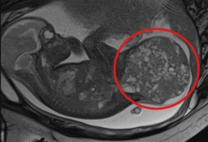 tumore risonanza magnetica fetale_tartoma 800 gr_3