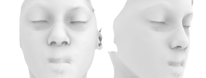 immagine 3d della ricostruzione del naso e del labbro effettuata al bambino gesù