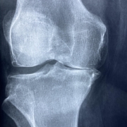 knee, x rays, arthritis, skeleton, health, patient, cartilage, orthopedics, anatomy, medicine, injury, joint, disease, diagnosis, inflammation, hospital, knee, arthritis, arthritis, arthritis, arthritis, arthritis