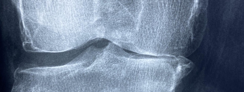 knee, x rays, arthritis, skeleton, health, patient, cartilage, orthopedics, anatomy, medicine, injury, joint, disease, diagnosis, inflammation, hospital, knee, arthritis, arthritis, arthritis, arthritis, arthritis