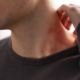 herpes zoster
