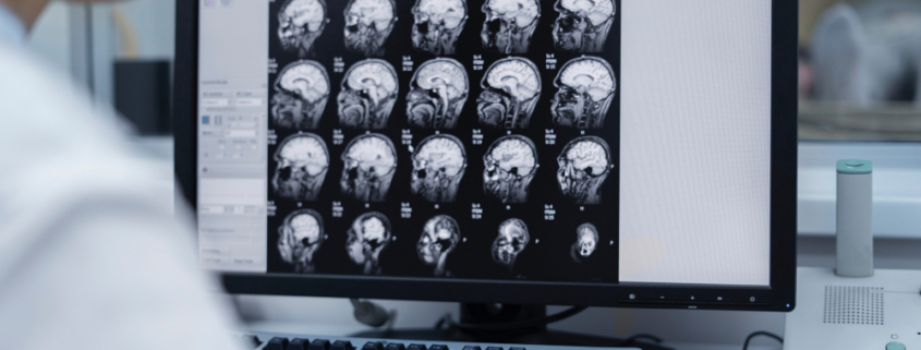 meningite, una risonanza al cervello