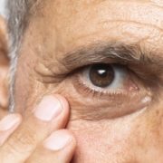 un uomo con il glaucoma mostra gli occhi