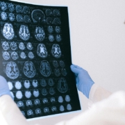 alzheimer