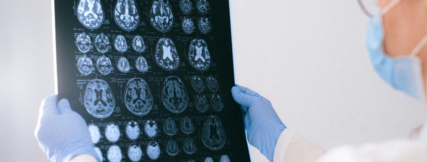 alzheimer