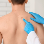 melanoma