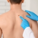 melanoma