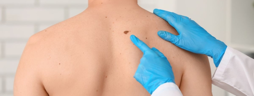 melanoma
