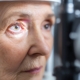 glaucoma