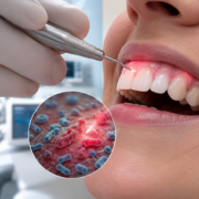 parodontite, una nuova terapia