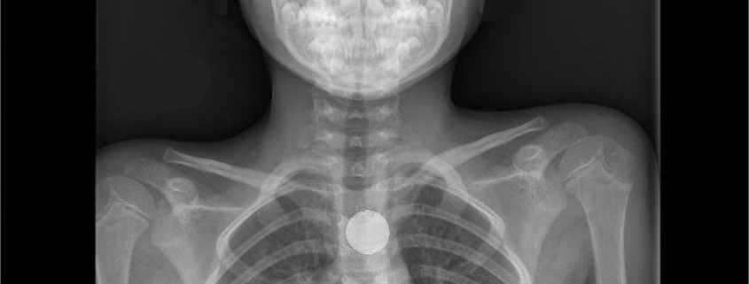 bambini, è allarme per le batterie a bottone 2 radiografia pila a bottone ingerita