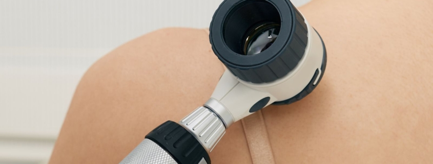melanoma: perché alcune cellule tumorali si nascondono dal sistema immunitario 1 melanoma