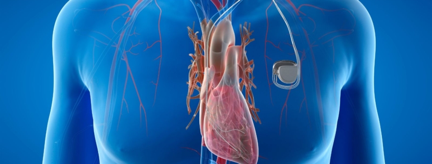 pacemaker